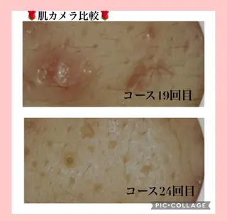 夏までに肌荒れ卒業 するサロン🌻のエステ・リラクイメージ