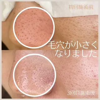 Belle et douce所属・毛穴ケア専門サロン ベルエドゥースのエステ・リラクイメージ