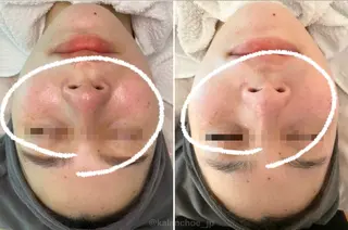 肌質改善 KALANCHOEのエステ・リラクイメージ