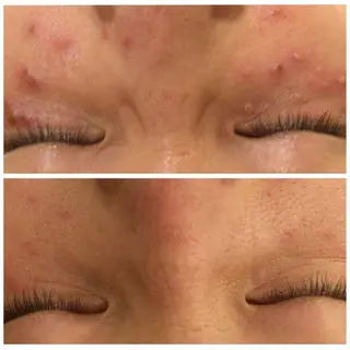 ロング カラー パーマ ヘアアレンジ メンズ キッズ ネイル マツエク・マツパ アイブロウ ニキビ特化型エステ 🍓最短で肌質改善のエステ・リラクイメージ