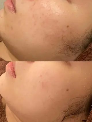 🔥3か月で肌革命 🔥ニキビ専門店のエステ・リラクイメージ