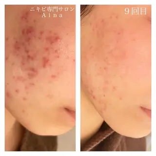 ショート カラー パーマ ヘアアレンジ メンズ キッズ ネイル マツエク・マツパ ニキビ跡専門サロン Ainaのエステ・リラクイメージ