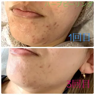 脱毛&美容サロンBLUESEA所属・脱毛&美容サロン BLUESEAのエステ・リラクイメージ