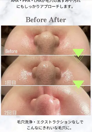 エイジングケアサロンBIOEL所属・肌質改善BIOELプ ラズマ/ラミピールのエステ・リラクイメージ