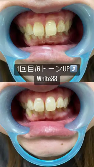 メンズ アイブロウ セルフホワイトニング White33大名のその他イメージ