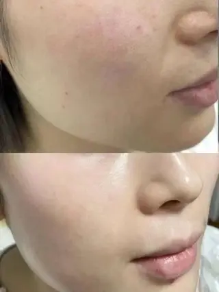 ネイル aliaハイフ&水光ジェットサロン所属・aliaハーブ水光店 エステティシャン募集のエステ・リラクイメージ