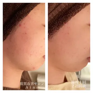 ミディアム カラー パーマ ヘアアレンジ メンズ キッズ ネイル マツエク・マツパ ニキビ跡専門サロン Ainaのエステ・リラクイメージ