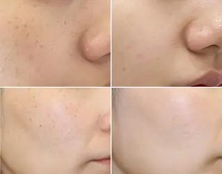 顔脱毛＆毛穴＆ニキビ 優良№1♪ヒロコ♪のエステ・リラクイメージ