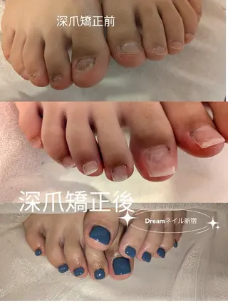 ネイル ネイリストゆか💅 長さだし、深爪矯正のネイルデザイン