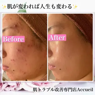 ニキビ・肌質改善専門 ♡人生が変わるサロンのエステ・リラクイメージ