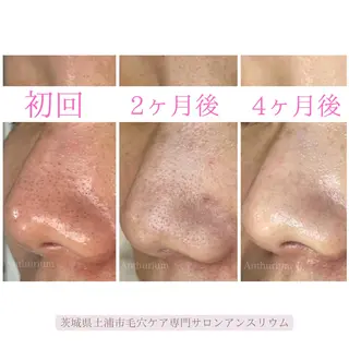 毛穴ケア専門サロンアンスリウム所属・茨城土浦 つくば毛穴 ケア専門サロンのエステ・リラクイメージ