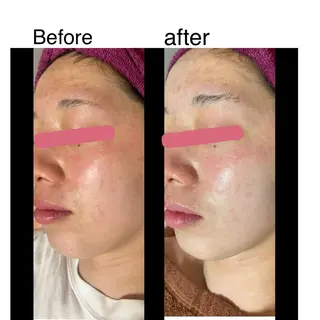 Nadia〜body &facial salon〜所属・【肌質改善】 ハーブピーリングのエステ・リラクイメージ