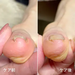 ネイル 深爪・巻き爪 専門サンセリテのネイルデザイン