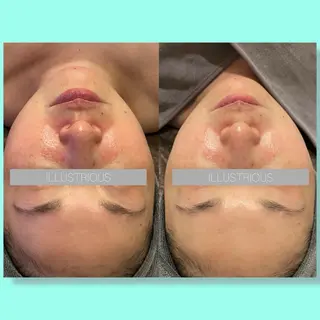 ☆痩身/小顔☆ ハイパーナイフexのエステ・リラクイメージ