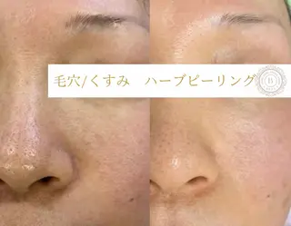 べアール所属・小顔/毛穴/ニキビ salon bealのエステ・リラクイメージ