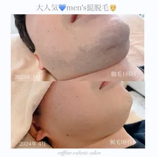 raffine  esthetic salon所属・🌻raffine 脱毛/まつ毛/ヘアーのエステ・リラクイメージ