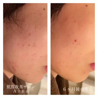 ロング カラー パーマ ヘアアレンジ メンズ キッズ ネイル マツエク・マツパ ニキビ跡専門サロン Ainaのエステ・リラクイメージ