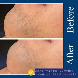 メンズ Meow！～トラブル肌専門ピーリング＆脱毛サロン～所属・トラブル肌改善🏥 Meow！🫧🫧のその他イメージ