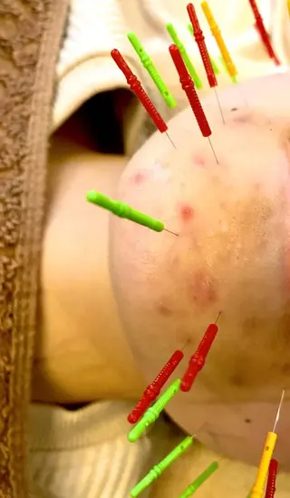 メンズ Acupuncture  salon LINOA リノア鍼灸院所属・ヘッドスパ鍼/小顔鍼 耳ツボ 　LINOAのエステ・リラクイメージ