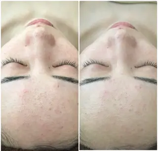 SILOE【ハーブピーリング/REVI/ニキビ/シミ/シワ/毛穴ケア】所属・【SILOE】 ハーブピーリングのエステ・リラクイメージ