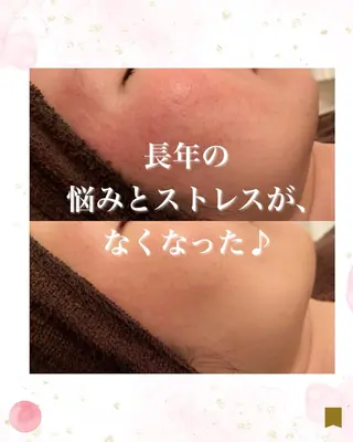 ニキビ跡専門サロン Ａｉｎａのエステ・リラクイメージ