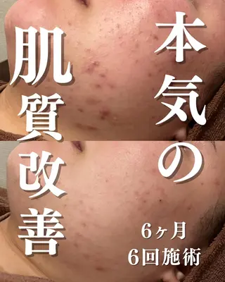 学生ニキビ改善🍀 優しい肌質改善のエステ・リラクイメージ
