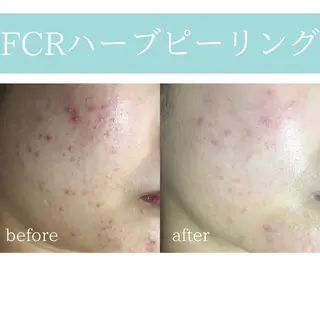 心斎橋痩身ダイエット 韓国.美容鍼.小顔のエステ・リラクイメージ