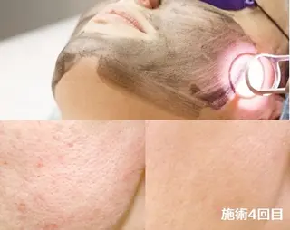 顔脱毛＆毛穴＆ニキビ 優良№1♪ヒロコ♪のエステ・リラクイメージ