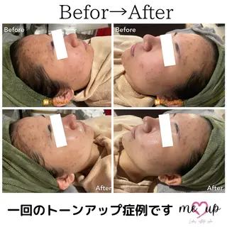 Meupニキビ専門店 背中/ハーブ/肌管理のその他イメージ