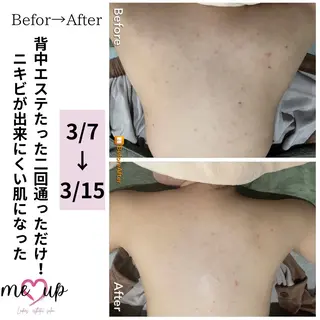 Meupニキビ専門店 背中/ハーブ/肌管理のその他イメージ