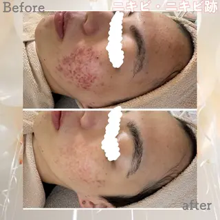 ニキビ&跡改善サロン オーナー光木のエステ・リラクイメージ