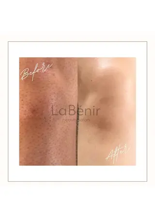 メンズ 脱毛/美肌【皮膚科看 護師経営】ラベニールのエステ・リラクイメージ