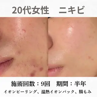 重度ニキビ専門🌷 ダウンタイムなしのエステ・リラクイメージ