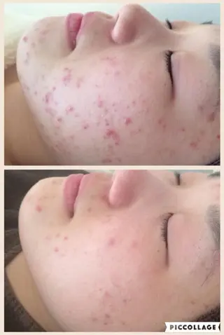 ニキビ跡改善専門🔥 医療にはできない改善のエステ・リラクイメージ