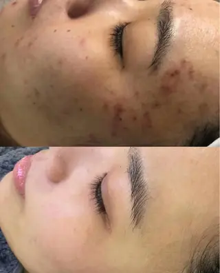 ネイル aliaハイフ&水光ジェットサロン所属・aliaハーブ水光店 エステティシャン募集のエステ・リラクイメージ