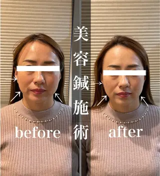 鍼灸整骨院Refine所属・鍼灸 Refineのその他イメージ