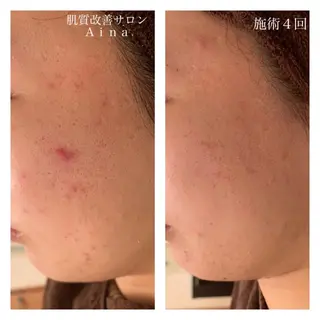 ロング カラー パーマ ヘアアレンジ メンズ キッズ ネイル マツエク・マツパ ニキビ跡専門サロン Ａｉｎａのエステ・リラクイメージ