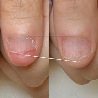 メンズ ネイル 深爪矯正専門店　ネイルサロン　トイロ所属・ネイルサロン トイロのネイルデザイン