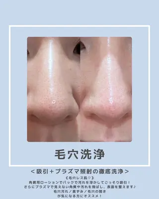 |ピーリング・毛穴| soina神楽坂のエステ・リラクイメージ