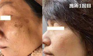 全身脱毛＆VIO脱毛 紹介率№1♪リナ♪のエステ・リラクイメージ