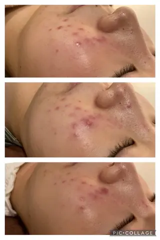 セミロング カラー パーマ ヘアアレンジ メンズ キッズ ネイル マツエク・マツパ アイブロウ ニキビ特化型エステ 🍓最短で肌質改善のエステ・リラクイメージ