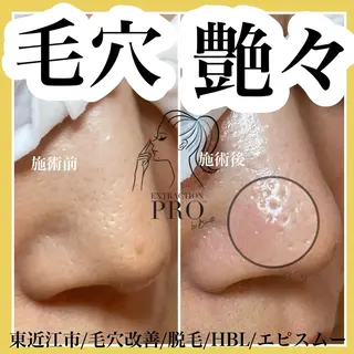 epismoo 脱毛/HBL/毛穴の眉毛・アイブロウイメージ