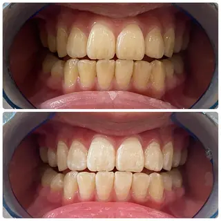 White Berry SELF BEAUTY SALON所属・セルフホワイトニング 🦷口元垢抜け✨のその他イメージ