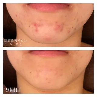 ミディアム カラー パーマ ヘアアレンジ メンズ キッズ ネイル マツエク・マツパ ニキビ跡専門サロン Ainaのエステ・リラクイメージ