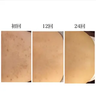 夏までに肌荒れ卒業 するサロン🌻のエステ・リラクイメージ