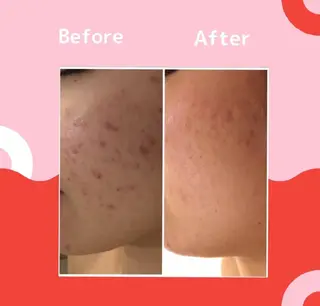 🔥3か月で肌革命 🔥ニキビ専門店のエステ・リラクイメージ