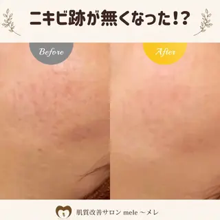 ニキビケア/毛穴/ 赤み/自信の肌✨森園のエステ・リラクイメージ
