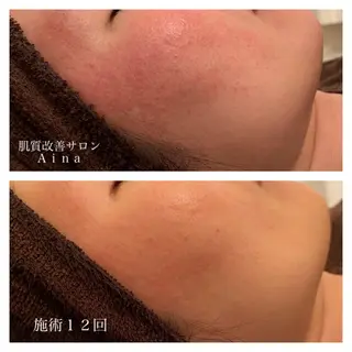 セミロング カラー パーマ ヘアアレンジ メンズ キッズ ネイル マツエク・マツパ ニキビ跡専門サロン Ainaのエステ・リラクイメージ