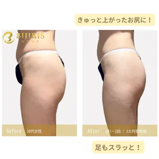 セルフ脱毛/美尻イス キングスサロン熊本のエステ・リラクイメージ