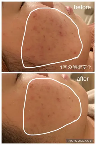 夏までに肌荒れ卒業 するサロン🌻のエステ・リラクイメージ